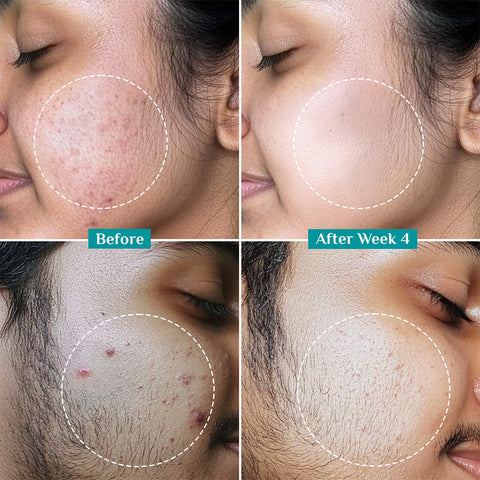 Pilgrim Anti Acne Serum 30 ml