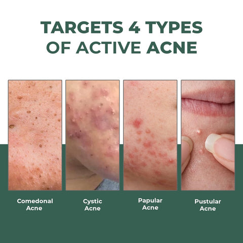 Conscious Chemist Acne Spot Corrector Gel - 15 gm