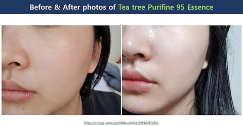 Dr.Ceuracle Tea Tree Purifine Essence, Waterless Formula, 50ml - Image 4