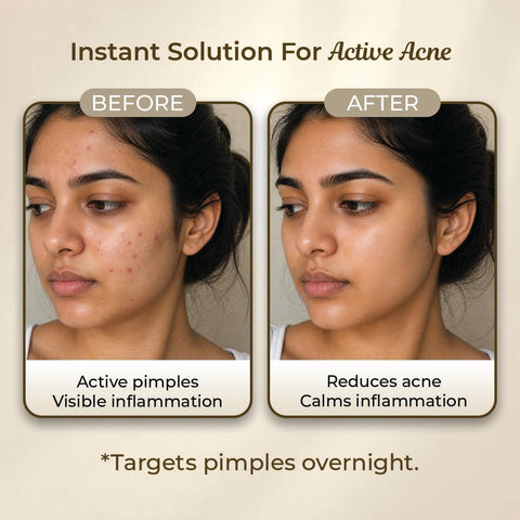 Sanfe Promise Face Acne Pimple Patch - Hydrocolloid Treatment, 36 Patches - Image 4