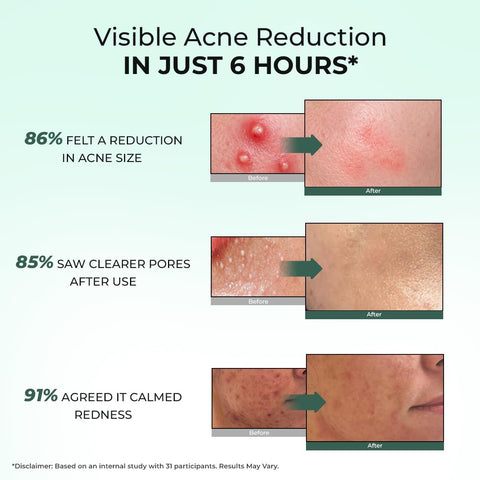 Conscious Chemist Acne Spot Corrector Gel - 15 gm