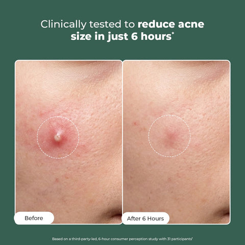 Conscious Chemist Acne Spot Corrector Gel - 15 gm