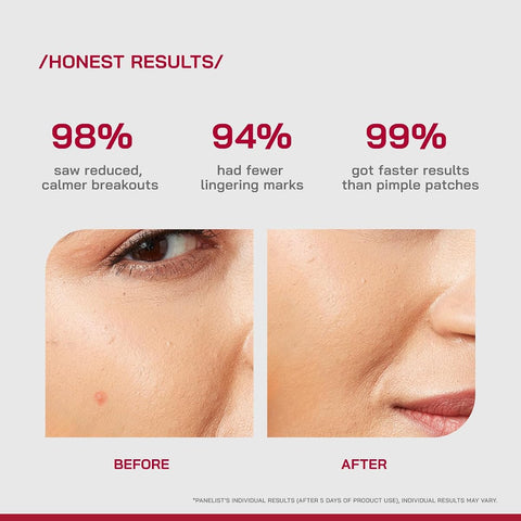 PHD Salicylic Acid Acne Spot Treatment Gel with Peptazin Complex - 10g - Image 4